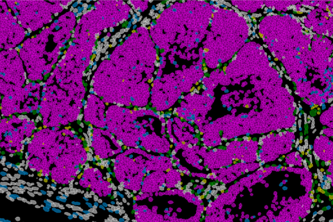 Un estudio en Alicante revela que la metástasis del cáncer de mama se origina en el tumor primario